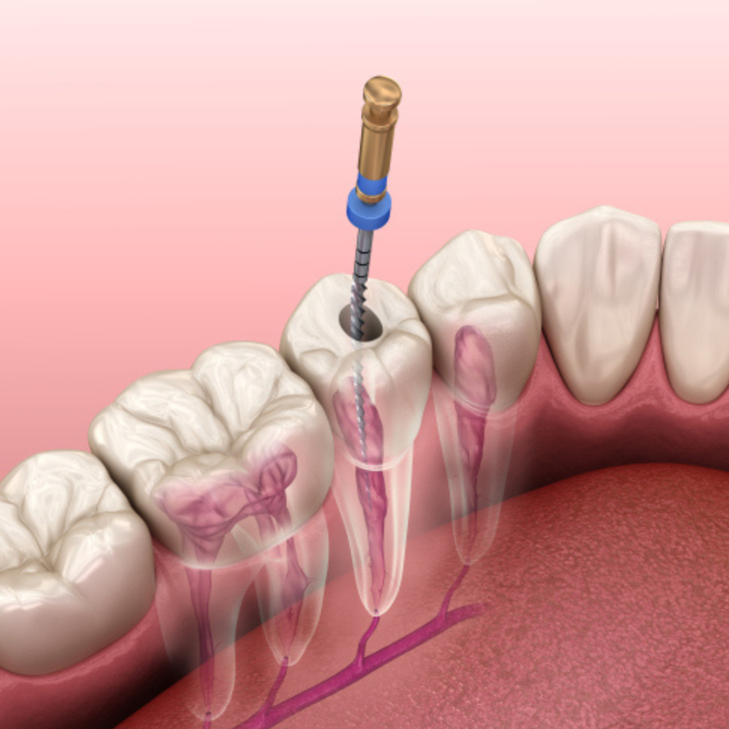 traitement d'endodontie par un dentiste