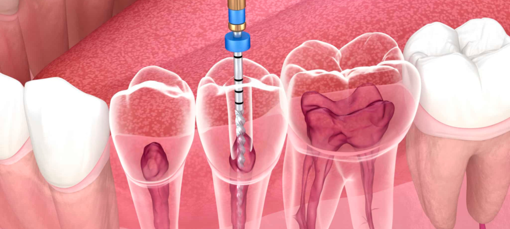 Endodontie dentaire