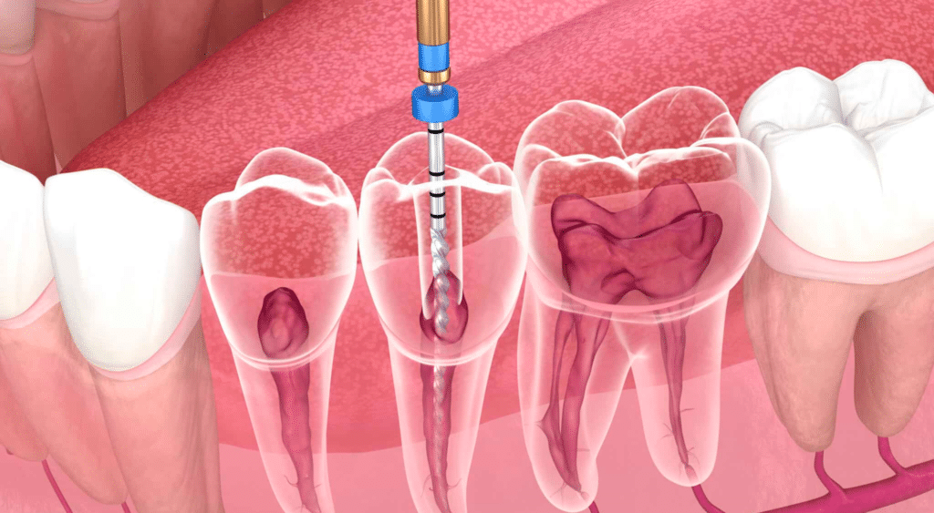 Traitement endodontique