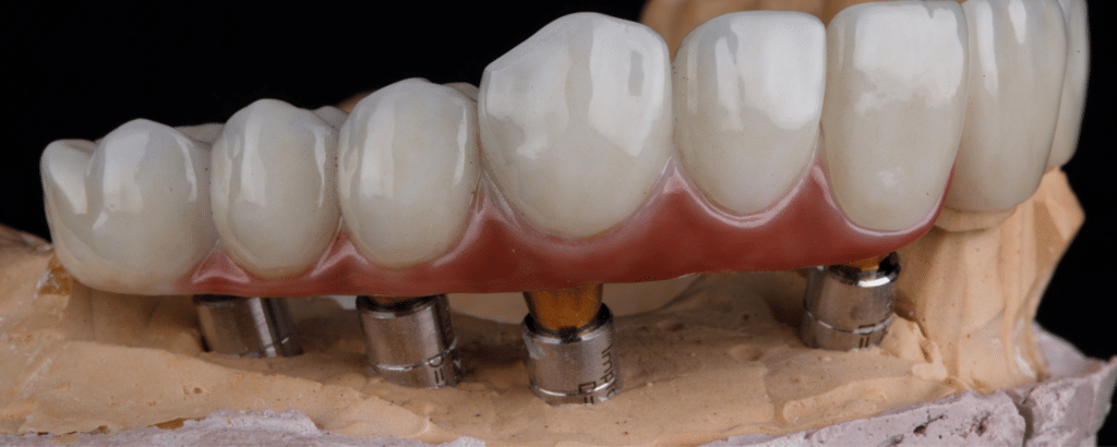 Insertion couronnes sur implants dentaires pour restaurer le sourire - Paris Dental Studios