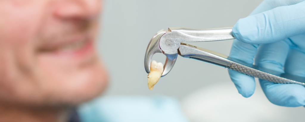 Transformation souriante: avant et après une extraction dentaire réussie à Paris Dental Studios.