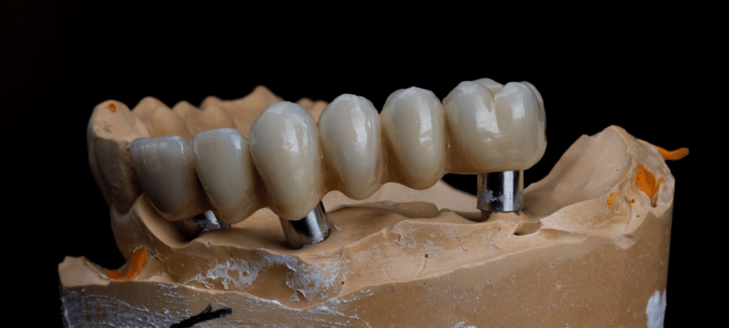 Bridge pour implants