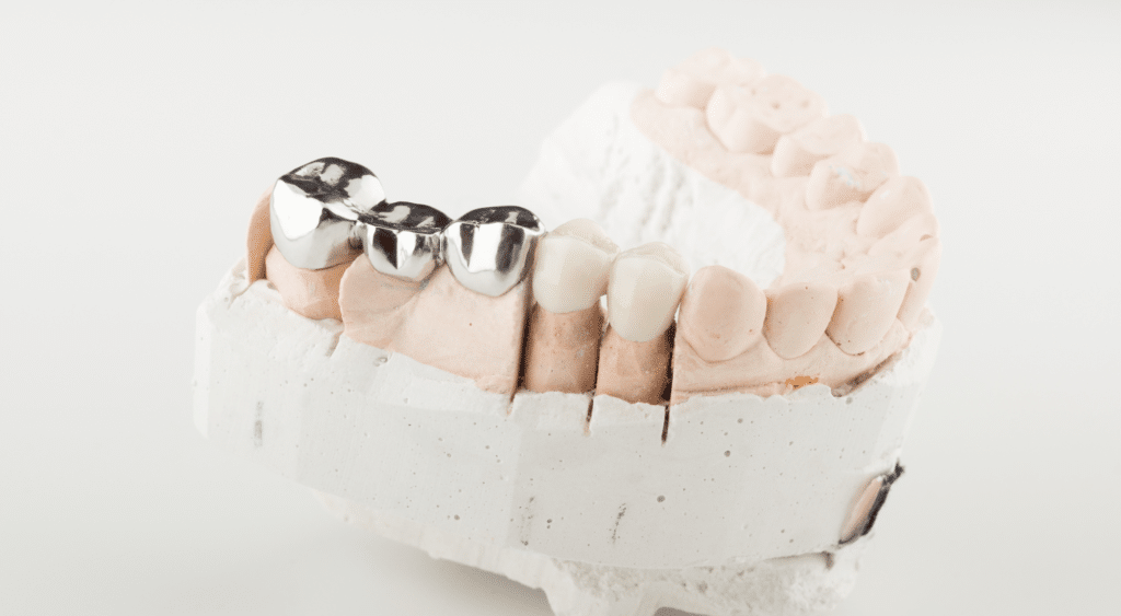 Types de prothèses dentaires - Paris Dental Studios