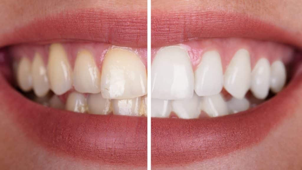 Comparaison avant/après blanchiment dentaire montrant une nette amélioration de la blancheur des dents.