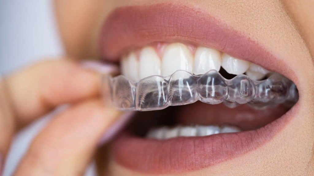 Pose d’un aligneur dentaire transparent sur les dents, une solution d’orthodontie discrète pour adulte.