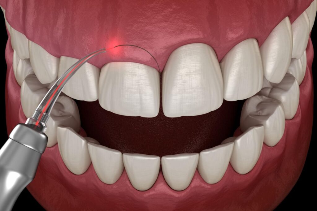 Gingivectomie à Paris au laser pour corriger un excès de gencive