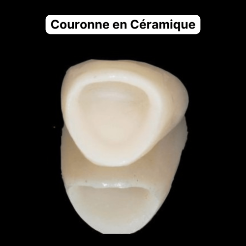 Couronnes en Céramique Transformation du sourire : des résultats impressionnants