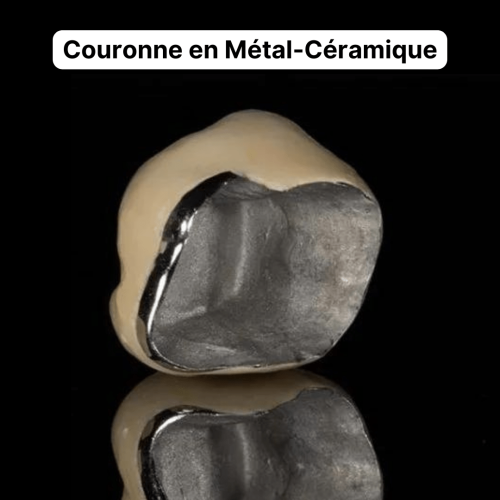 Couronnes en Métal-Céramique prothèse dentaire